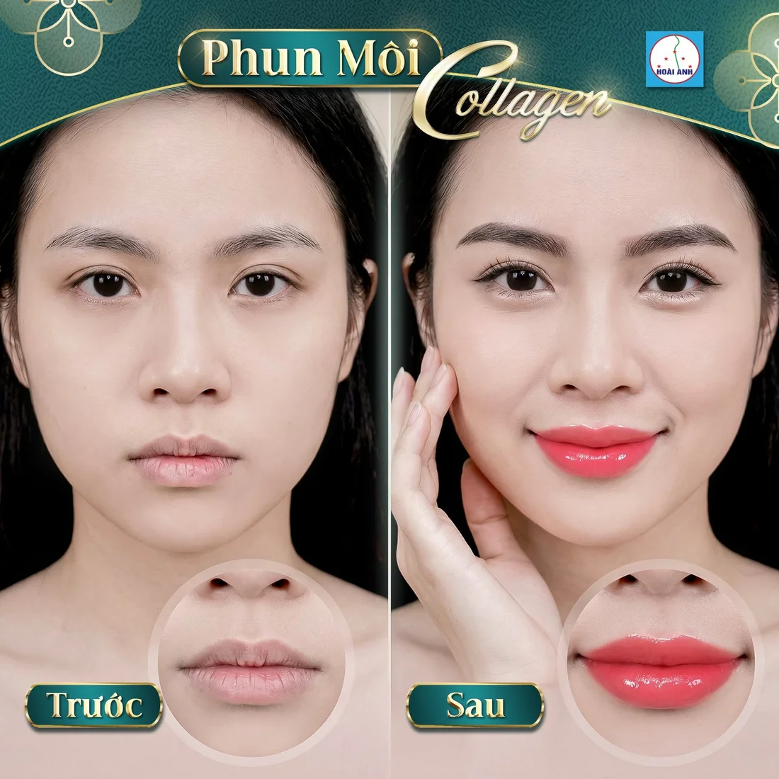 Kết quả phun môi tại Hoài Anh