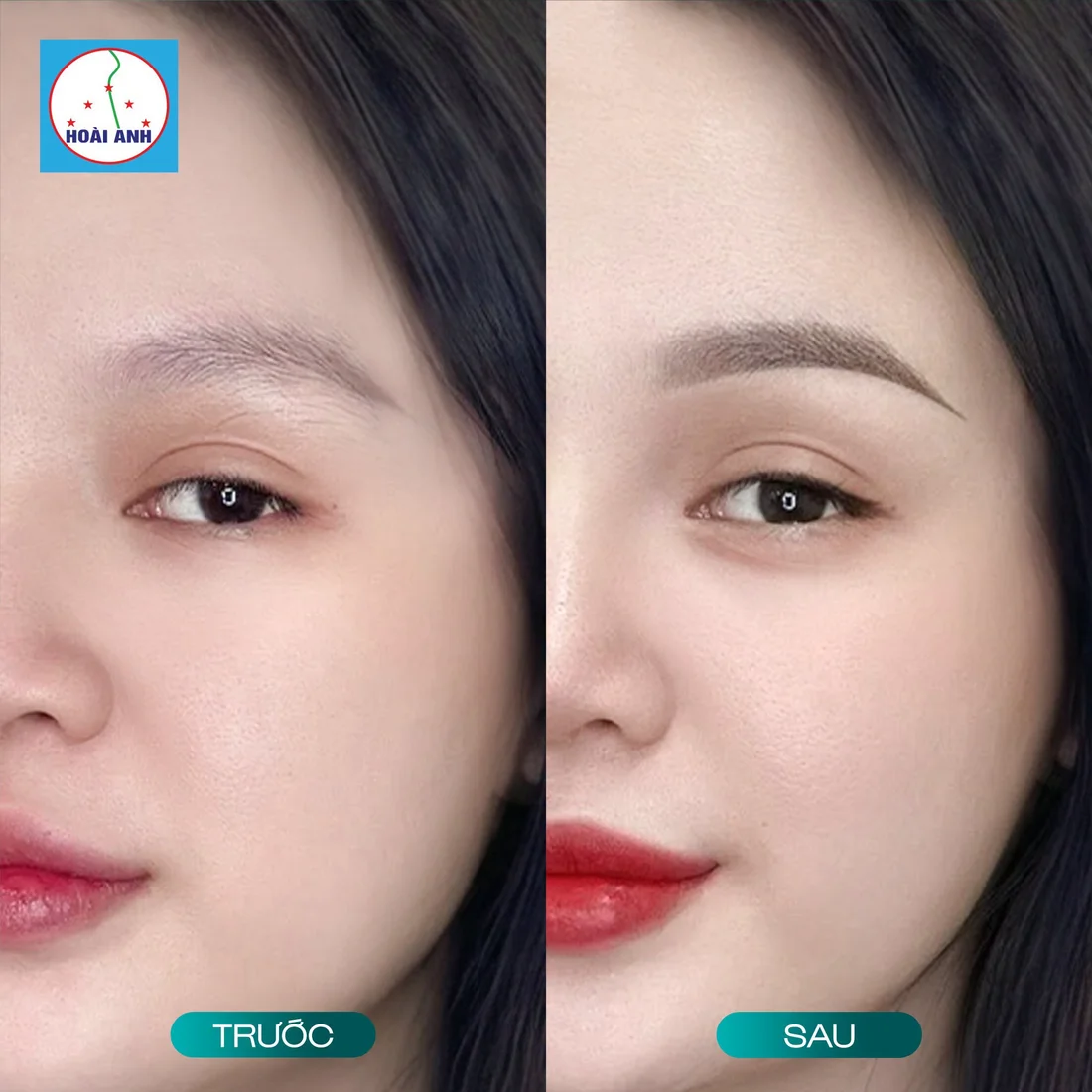 Kết quả phun môi tại Hoài Anh