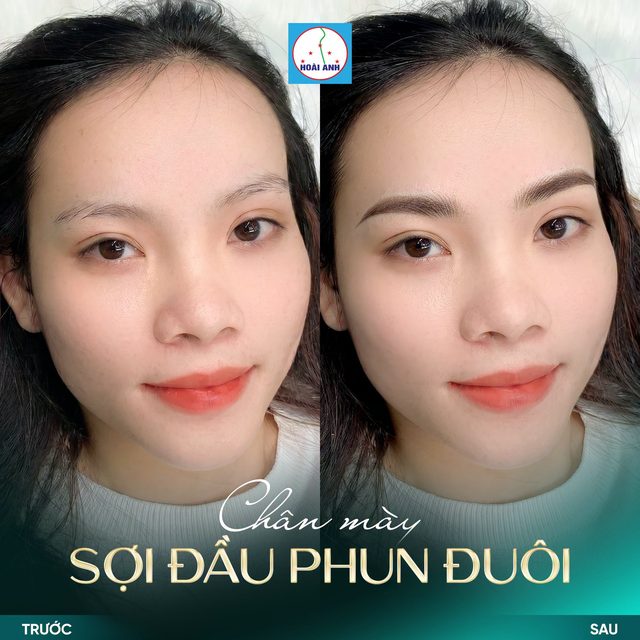 Xóa mày cũ bằng laser có hại không?