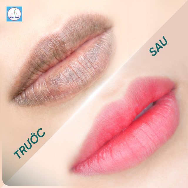 Kết quả phun môi tại Hoài Anh