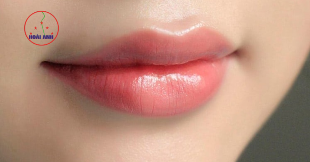phun môi collagen tại thẩm mỹ viện hoài anh