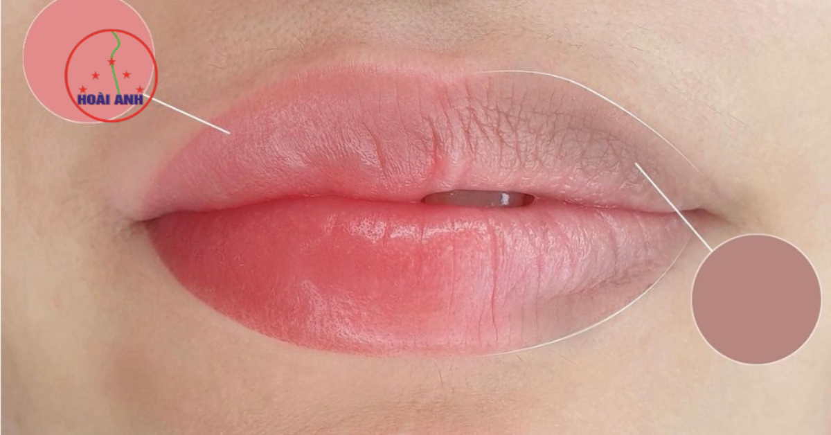 phun môi trị thâm