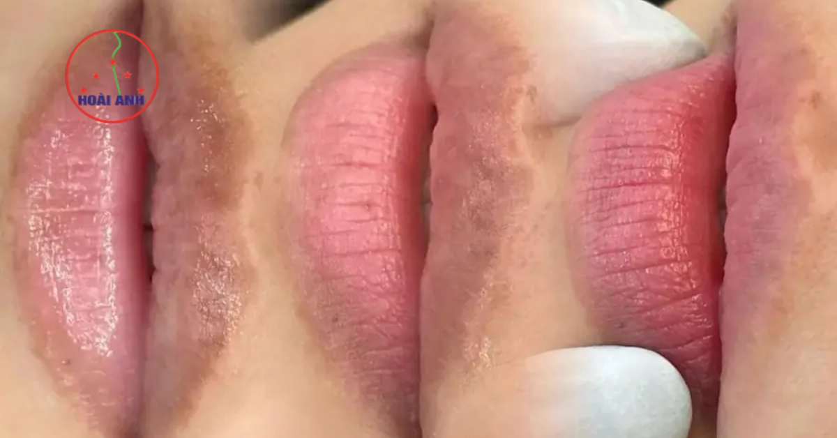 phun môi trị thâm hoài anh