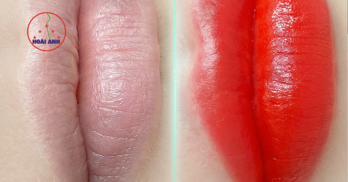 Kết quả phun môi tại Hoài Anh