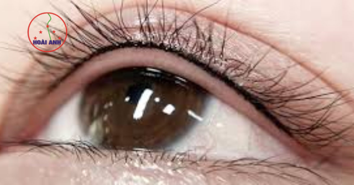 Kỹ thuật phun mí đẹp tự nhiên tại Hoài Anh