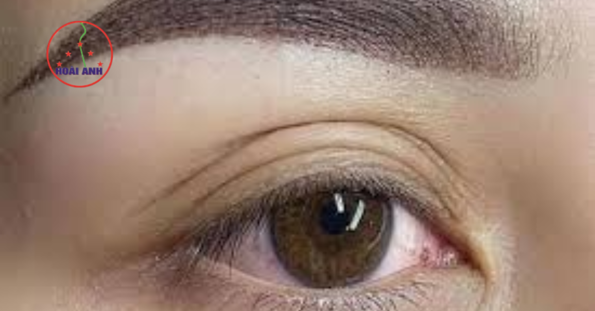 Phun mí siêu vi chạm hạt giúp mắt rõ nét