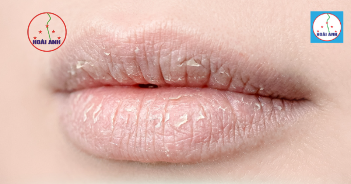 Đôi môi trước khi xử lý thâm