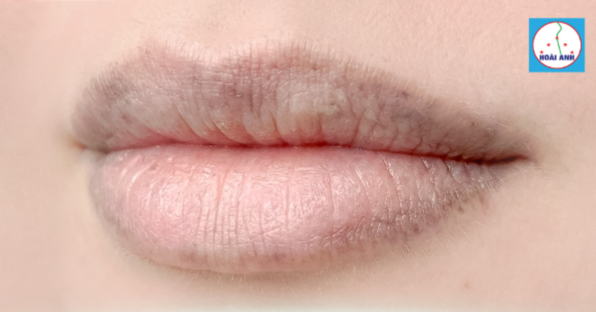 Đôi môi trước khi xử lý thâm