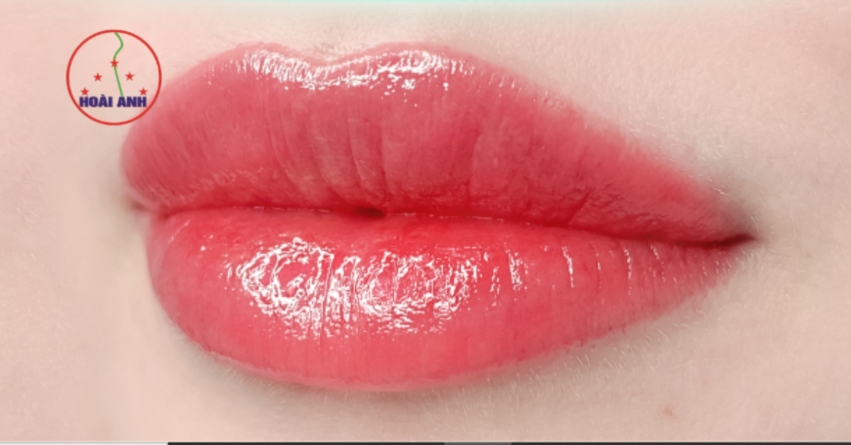Đôi môi sau khi xử lý thâm tại MTV Hoài Anh