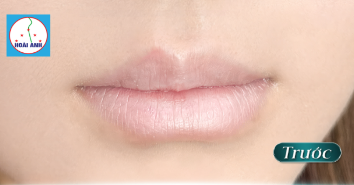 Đôi môi khô trước khi phun tại TMV Hoài Anh
