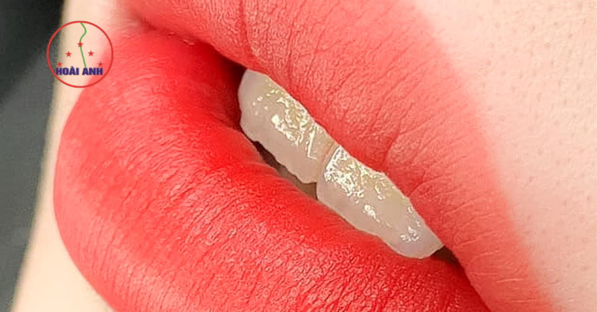 Phun môi khử thâm tự nhiên tại TMV Hoài Anh