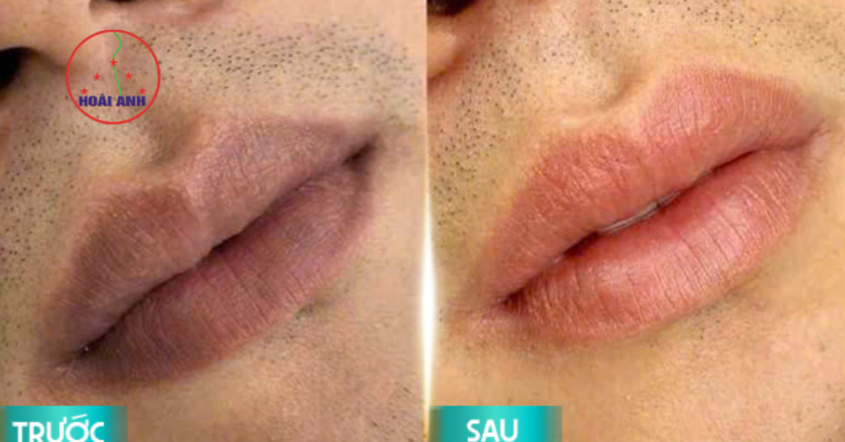 Khử thâm môi cho nam tự nhiên