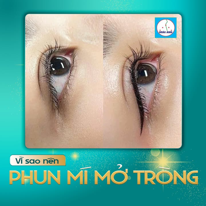 Phun mí với mực thảo dược tại Thẩm Mỹ Viện Hoài Anh
