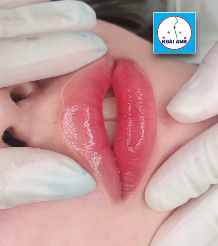 Giải đáp phun môi có bị sưng không tại Thẩm Mỹ Viện Hoài Anh