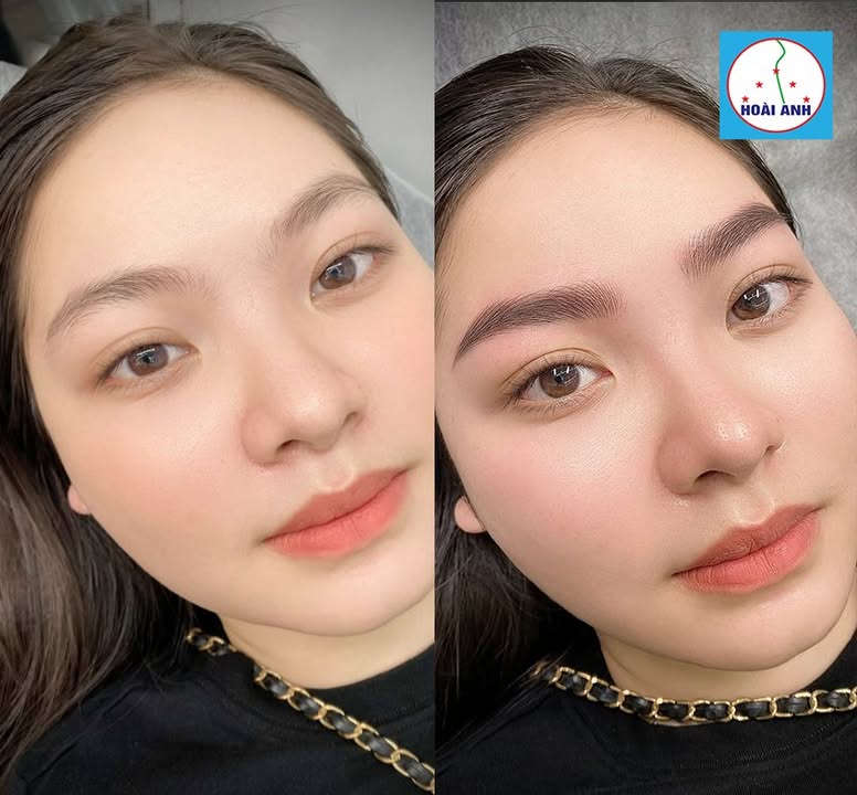 Khắc phục chân mày hỏng theo từng tình trạng tại Thẩm Mỹ Viện Hoài Anh