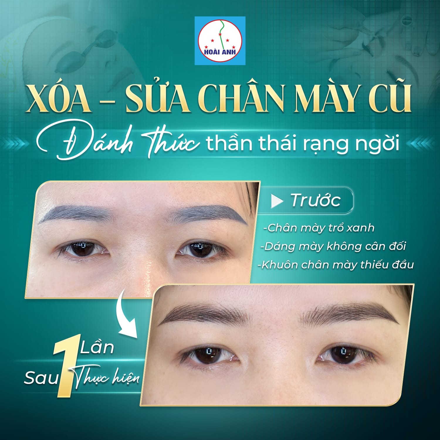 Sửa mày hỏng, chỉnh mày lệch tại Thẩm Mỹ Viện Hoài Anh