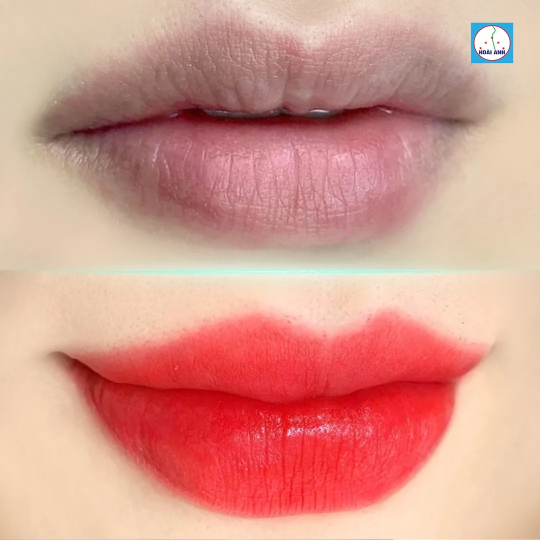 Quy trình khử thâm môi chuyên sâu
